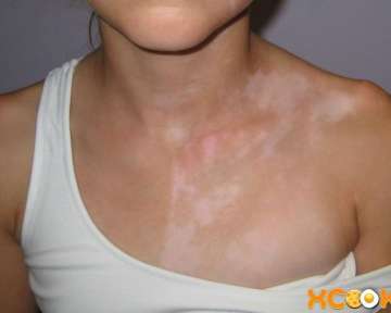 Белые пятна на коже после загара – причины, почему появились и способы лечения