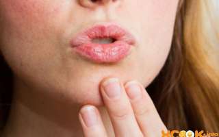 Заеды в уголках рта у взрослых и детей – причины появления, симптомы и способы быстрого лечения народными средствами или мазями