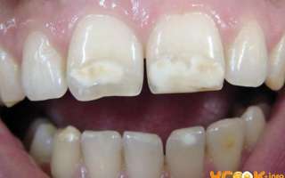 Белые пятна на зубах — что это такое?