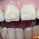 Белые пятна на зубах — что это такое?