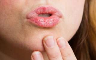 Причины, почему сильно сохнут губы, признаки заболеваний, а также способы лечения