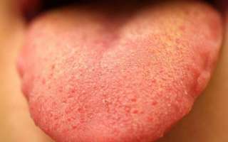 Белые и красные болячки на языке у взрослого или ребенка – причины появления и способы лечения в домашних условиях