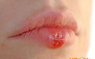 Герпес на губах — симптомы заболевания; профилактика и лечение народными средствами