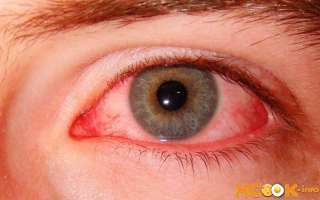 Красные глаза — симптомы, причины и лечение