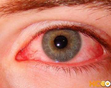 Красные глаза — симптомы, причины и лечение