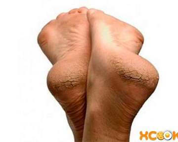 Грубая кожа пяток и трещены — причины; уход в салоне и в домашних условиях; рецепты народных средств