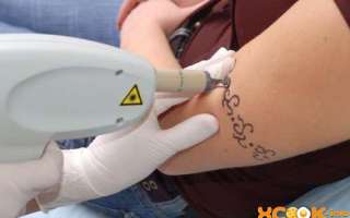 Удаление татуировок — лазером и другими способами; выведение тату в домашних условиях