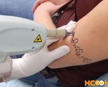 Удаление татуировок — лазером и другими способами; выведение тату в домашних условиях