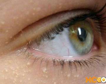 Жировик на верхнем или нижнем веке, а также в углу глаза у ребенка и взрослого – причины появления и как избавиться в домашних условиях?