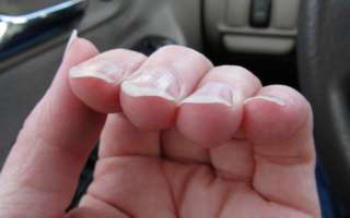 Причины, почему ногти стали толстыми и твердыми, а также лечение