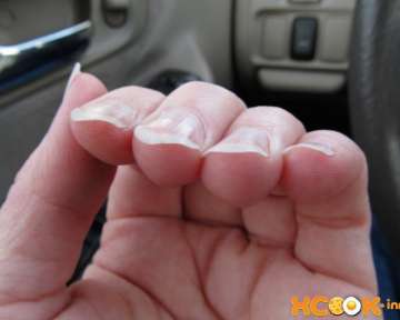 Причины, почему ногти стали толстыми и твердыми, а также лечение