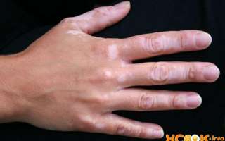 Большие и маленькие белые пятна на коже рук у ребенка и взрослого – почему появились и как лечить в домашних условиях?