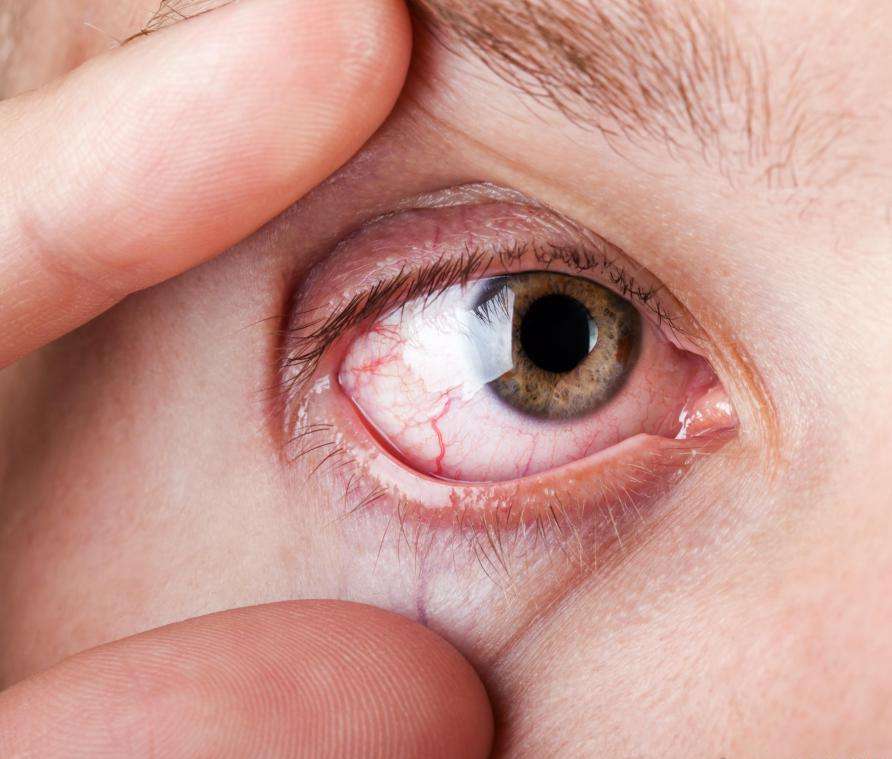 Покраснение глаз — что это? Причины и как лечить красные глаза
