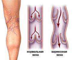 симптомы варикоза ног