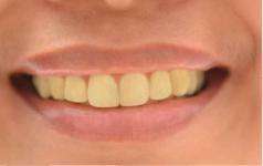 причины желтизны зубов