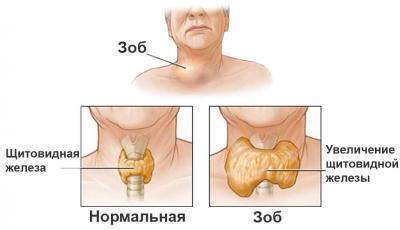 щитовидная железа и недостаток йода