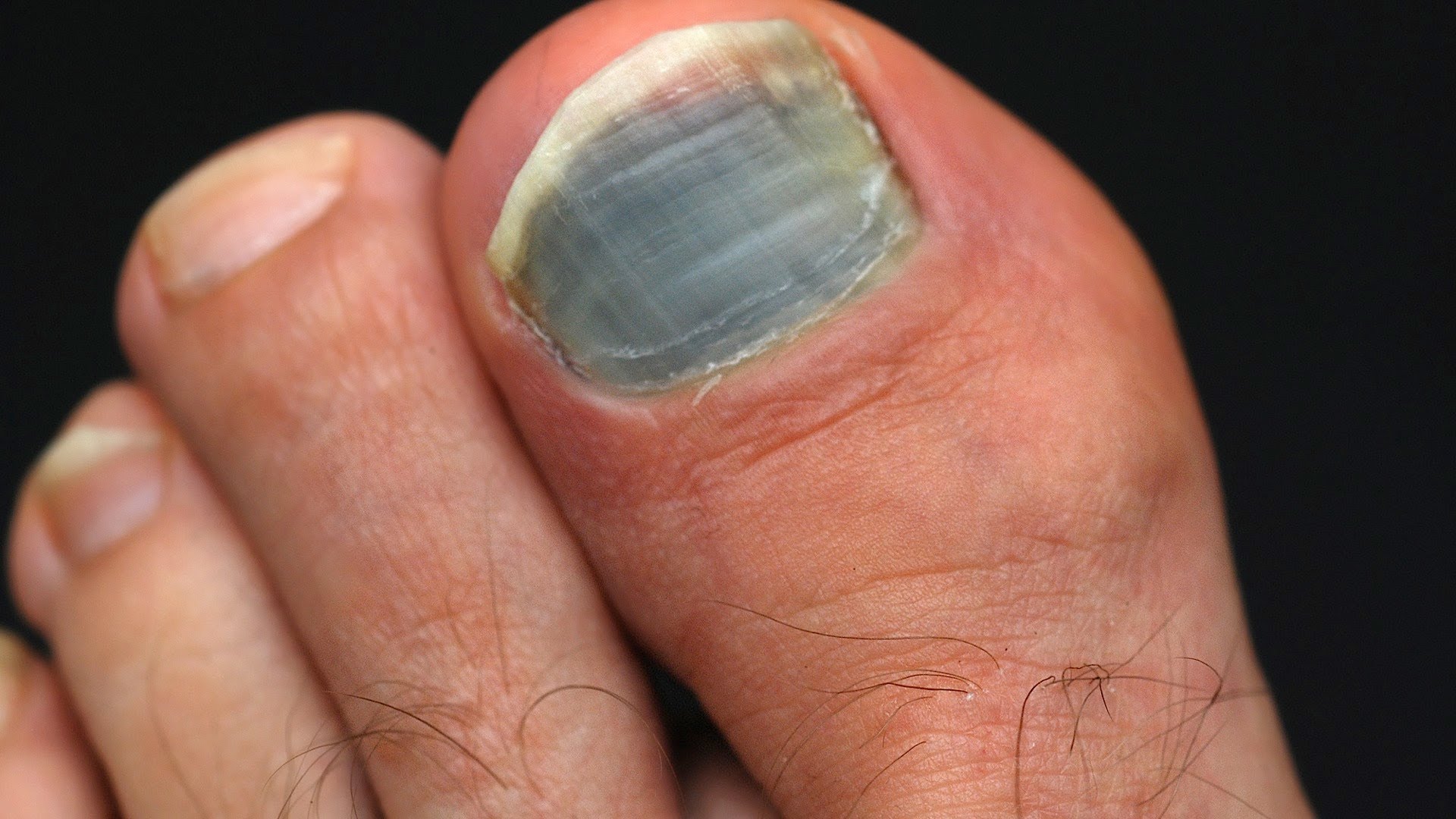 Названы опасные болезни, при которых синеют ногти