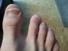 грибок на ногтях ног
